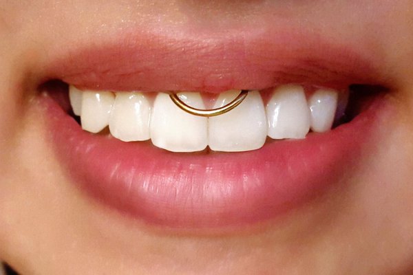 Пірсинг смайл