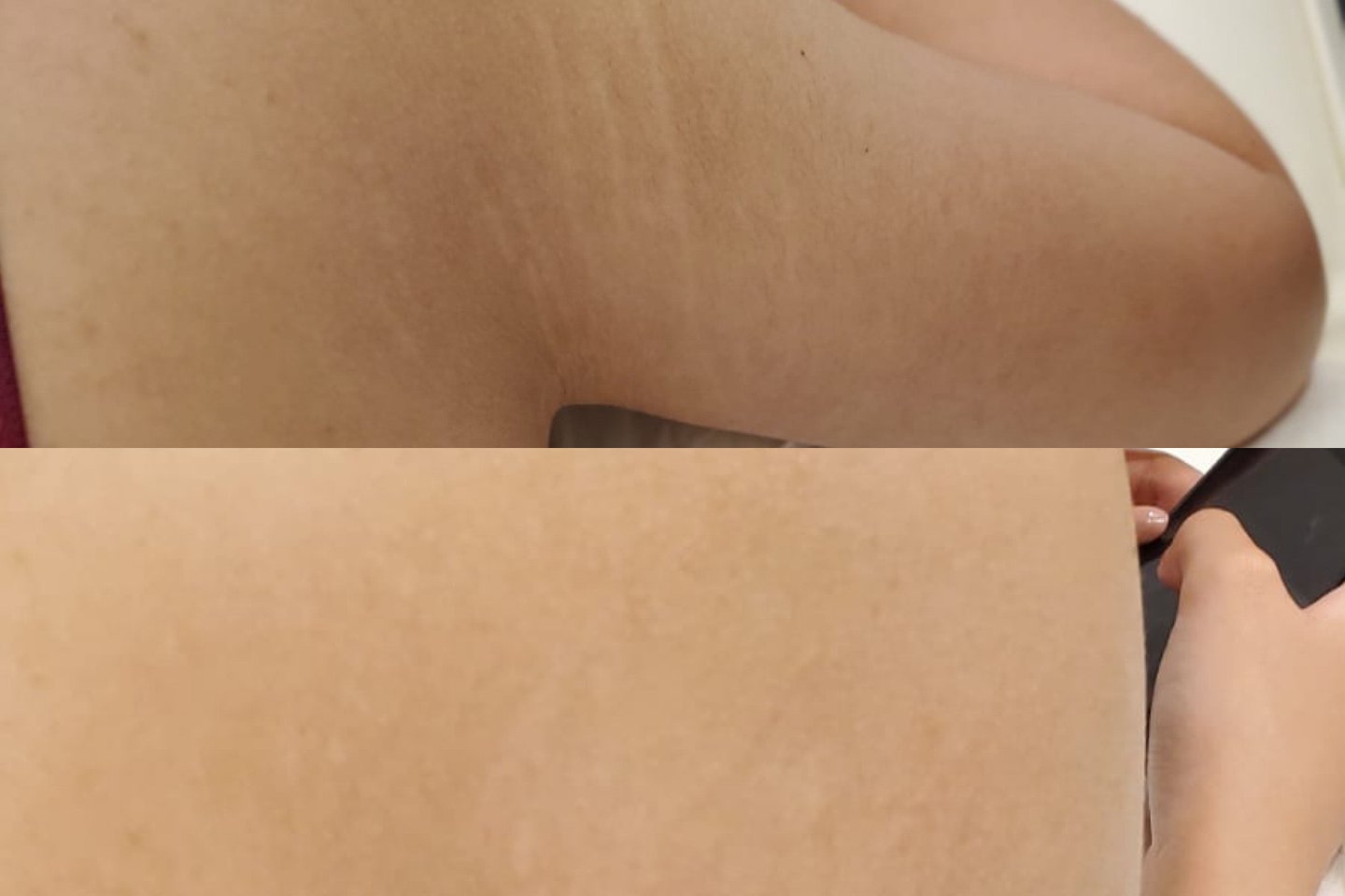 Татуаж шрамів і рубців