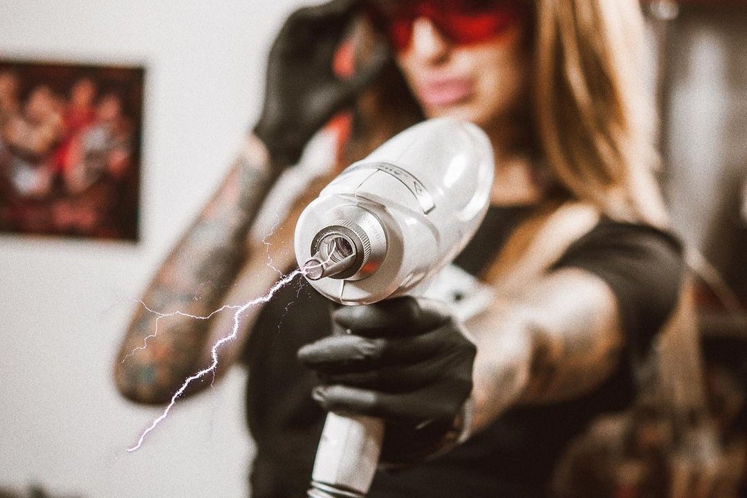 удаление татуажа в Никополе