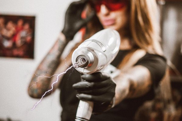 Удаление тату в Николаеве