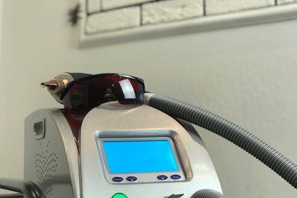 Видалення татуажу в Калуші