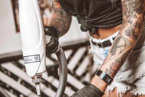 Удаление тату в Николаеве