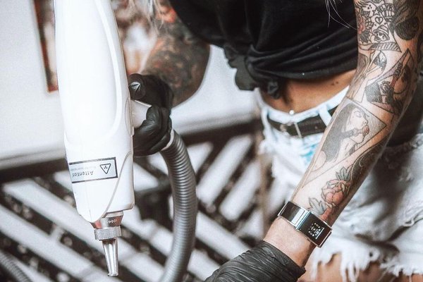 Удаление тату в Запорожье