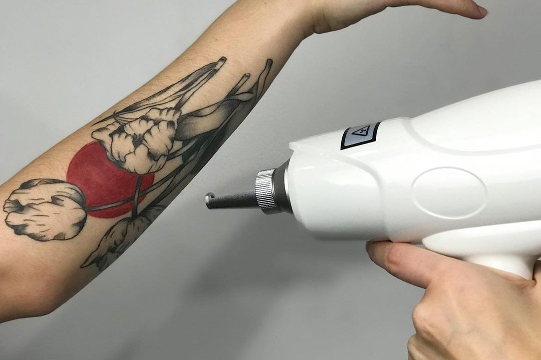 Удаление татуировки в Херсоне