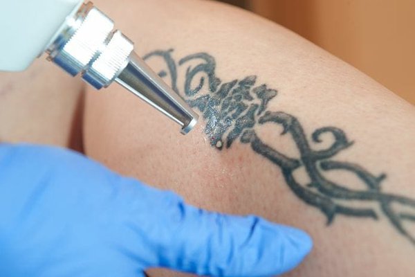 Advantages of laser removal