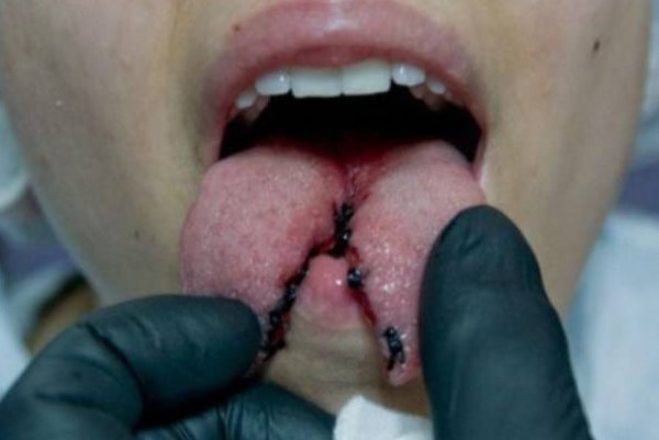 Спліт язика