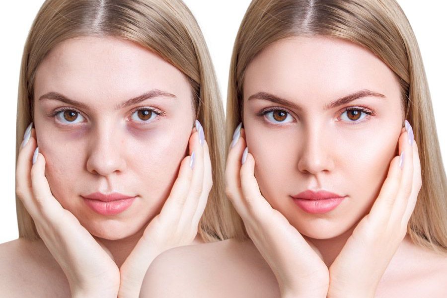 Татуаж кругов под глазами