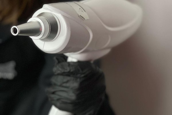 Лазерне видалення тату: ефективність, ризики