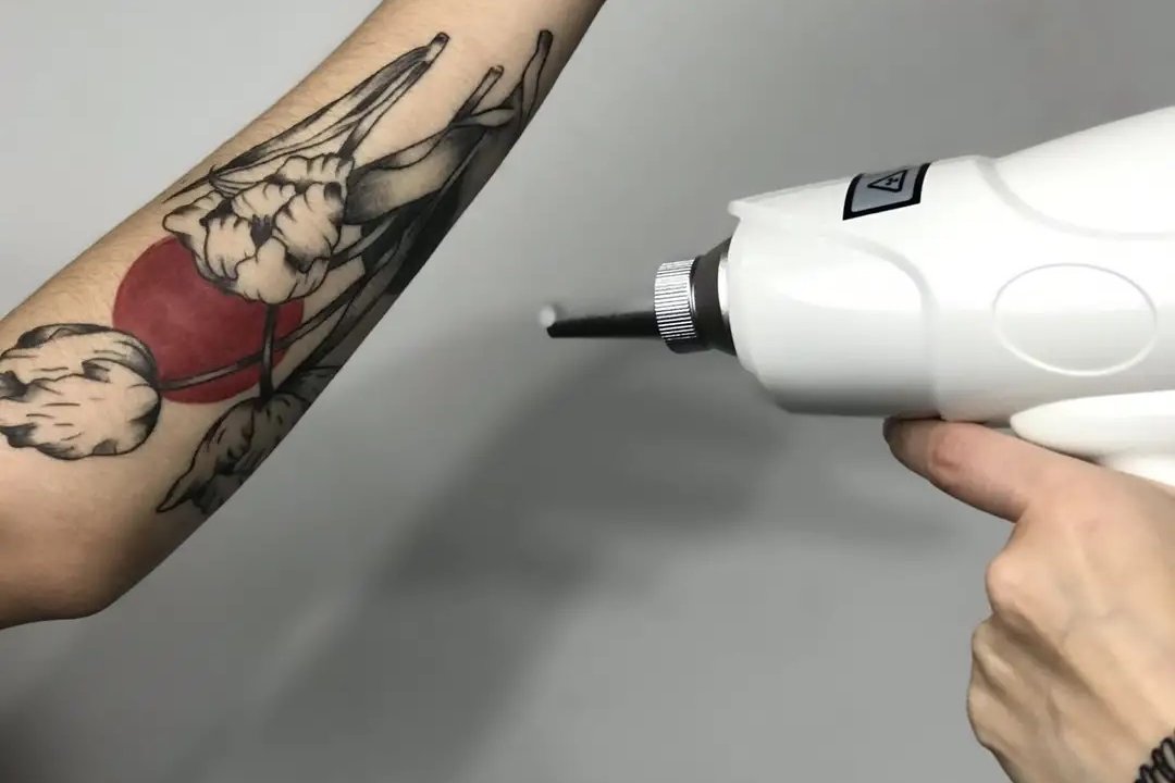 Видалення тату в Дніпрі