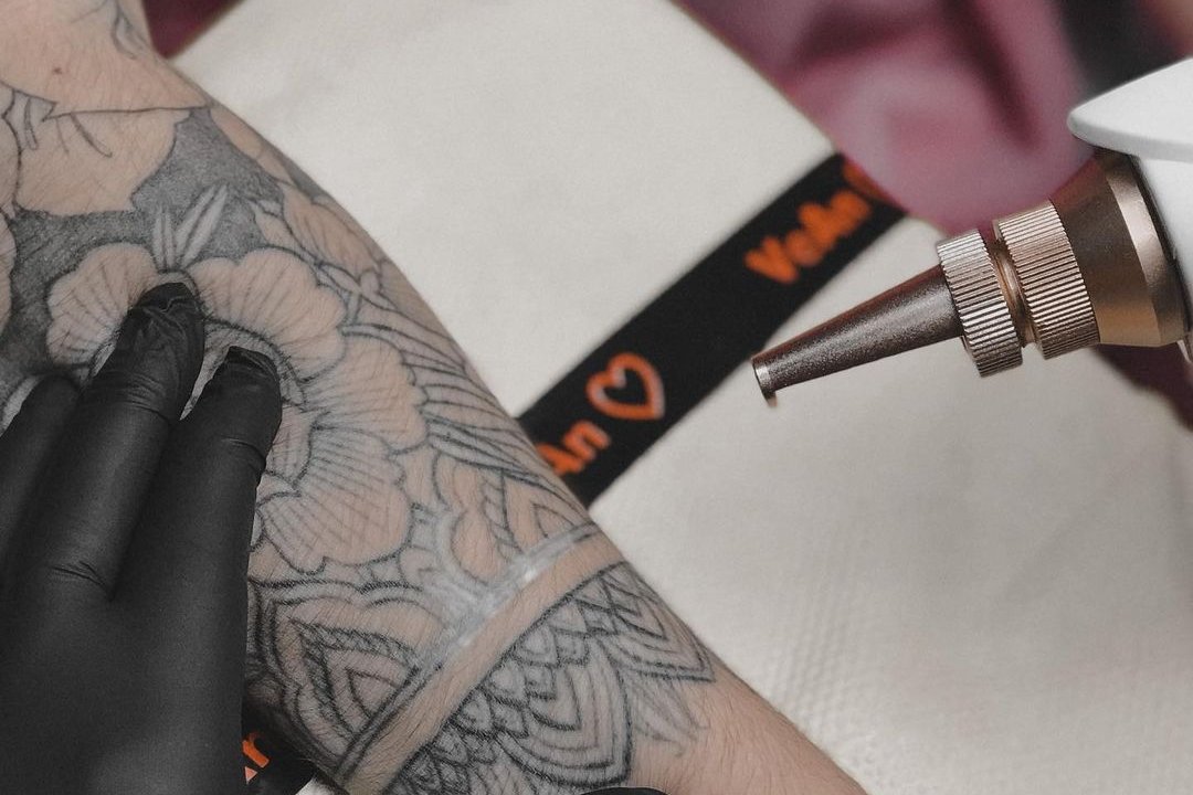 Удаление тату в Мукачево