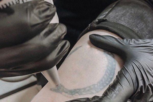 Видалення тату в Умані