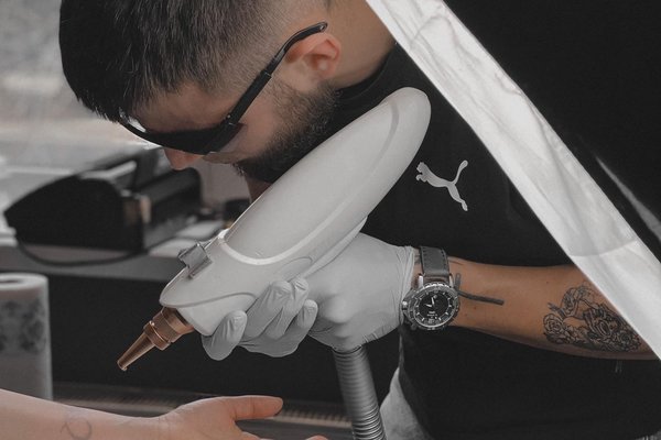 Видалення тату в Києві