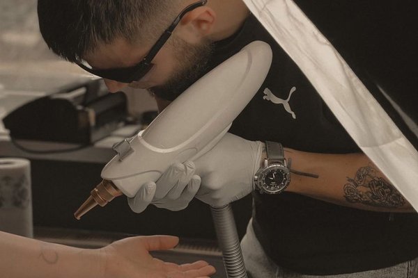 Видалення тату у Сумах