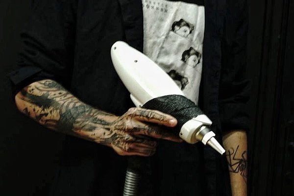 Видалення тату в Умані