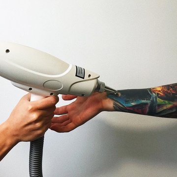 Удаление тату в Житомире