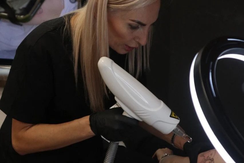 Видалення тату в Черкасах