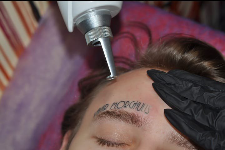 Removal of tattoos in Lviv