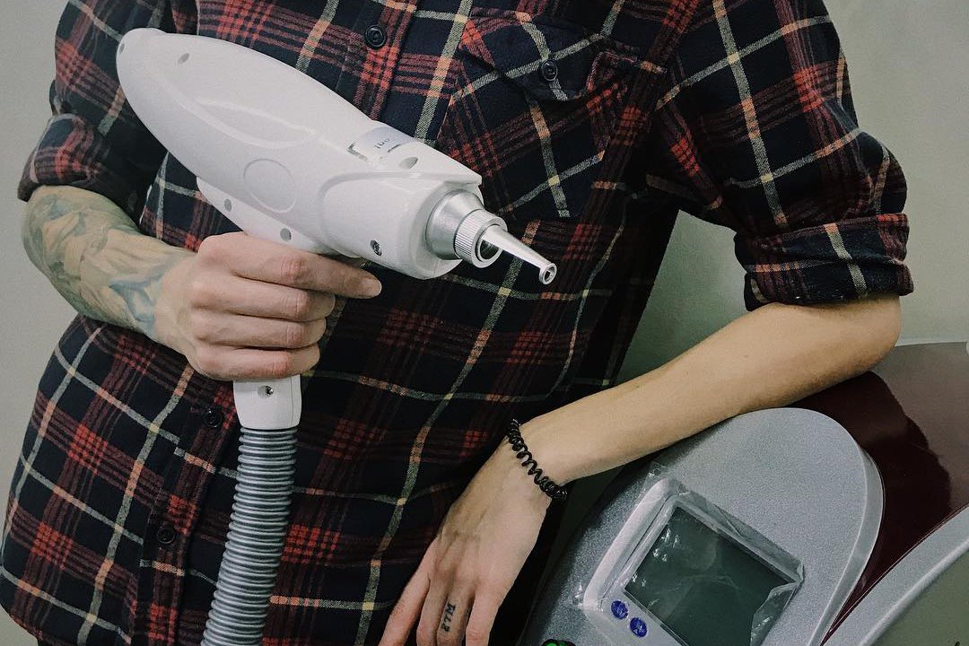 Удаление тату во Львове