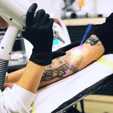 Удаление тату в Херсоне