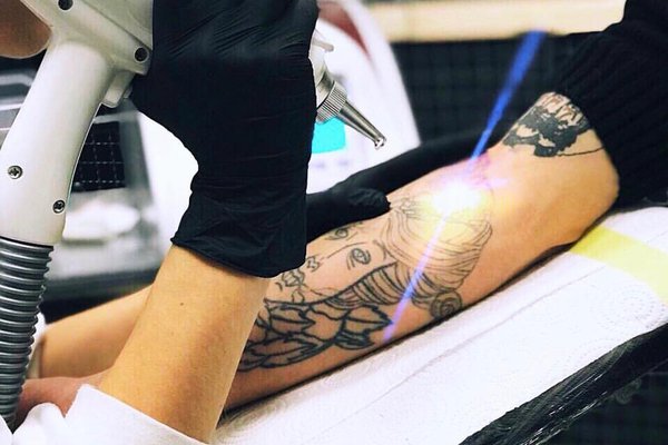 Laser tattoo removal from VeAn