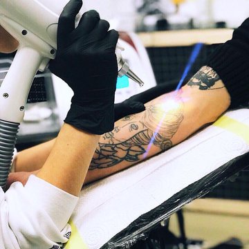 Видалення тату в Києві