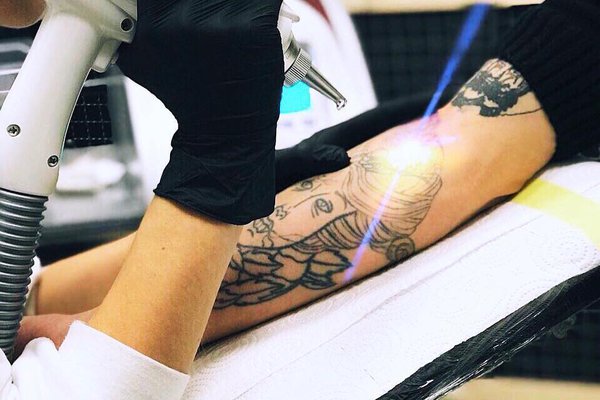 Удаление перманентного макияжа