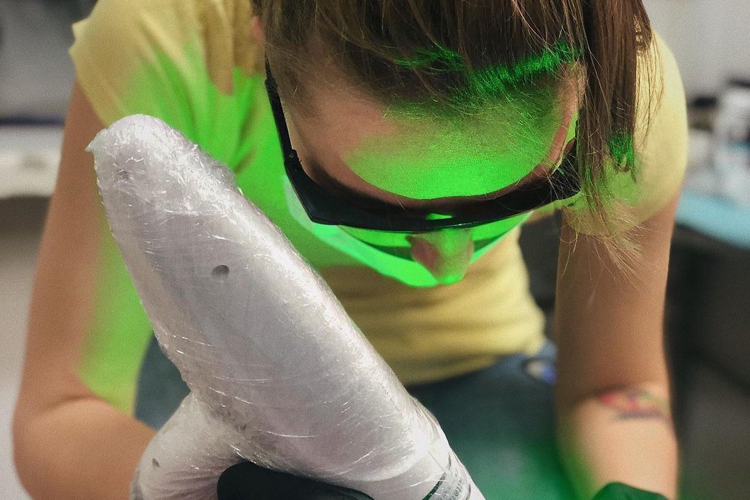 Tattoo removal in Chernivtsi