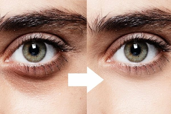 Татуаж кругов под глазами