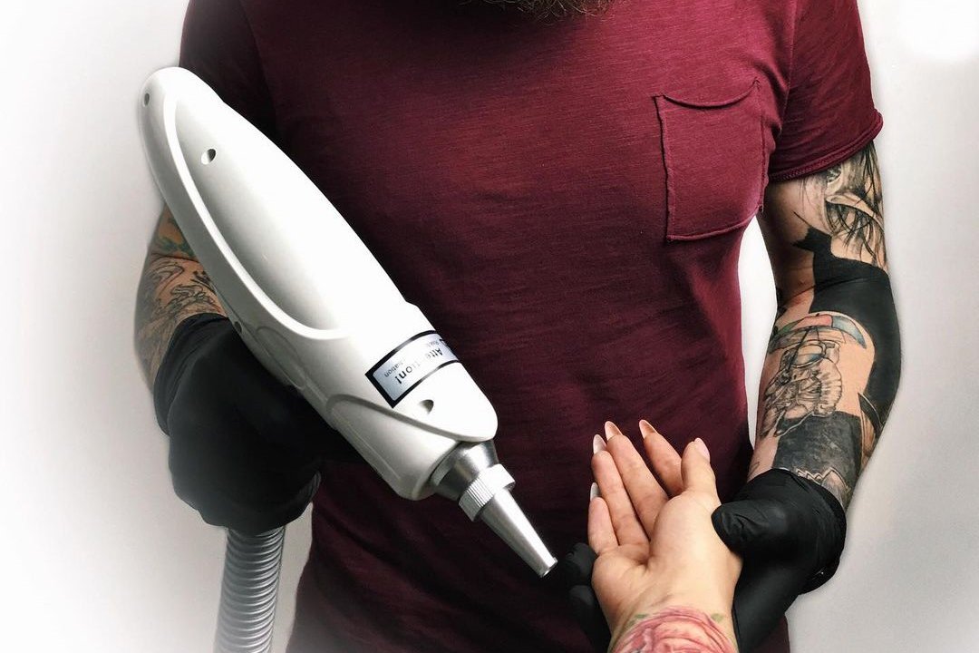 Tattoo removal in Uzhgorod