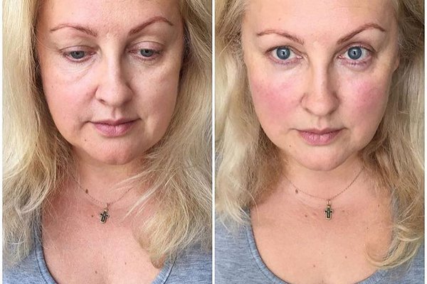 Татуаж кругов под глазами