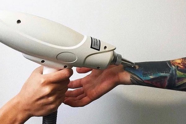 Удаление тату в Ивано-Франковске