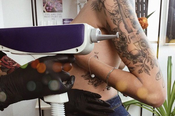 Эффективность лазерного удаления