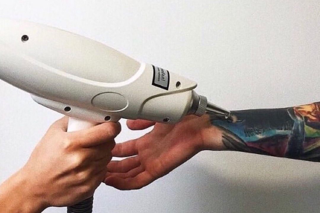 Tattoo removal in Kharkiv