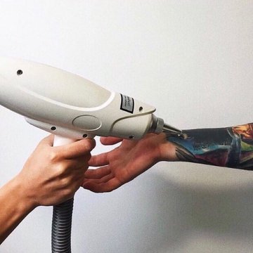 Удаление татуировки в Харькове