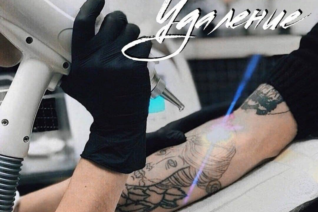 удаление тату в Никополе