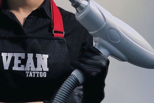 Удаление татуировки в Одессе