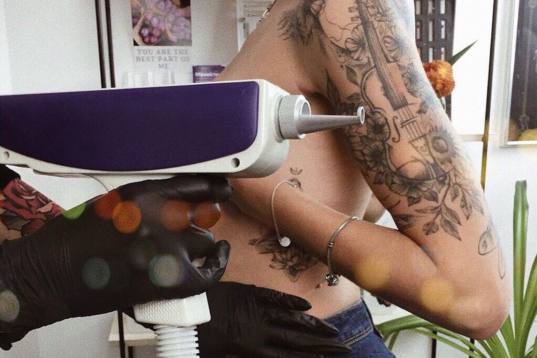 Удаление татуировки в Запорожье