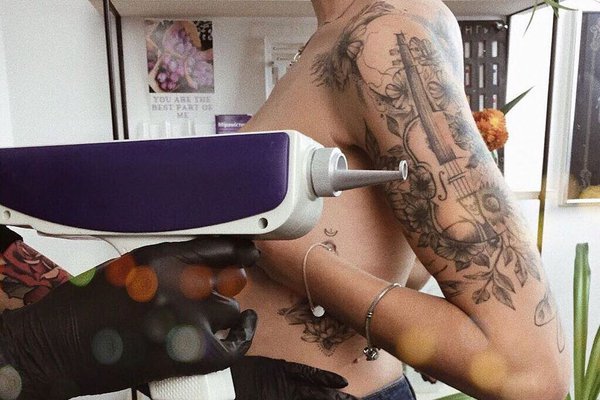 Удаление тату в Ивано-Франковске