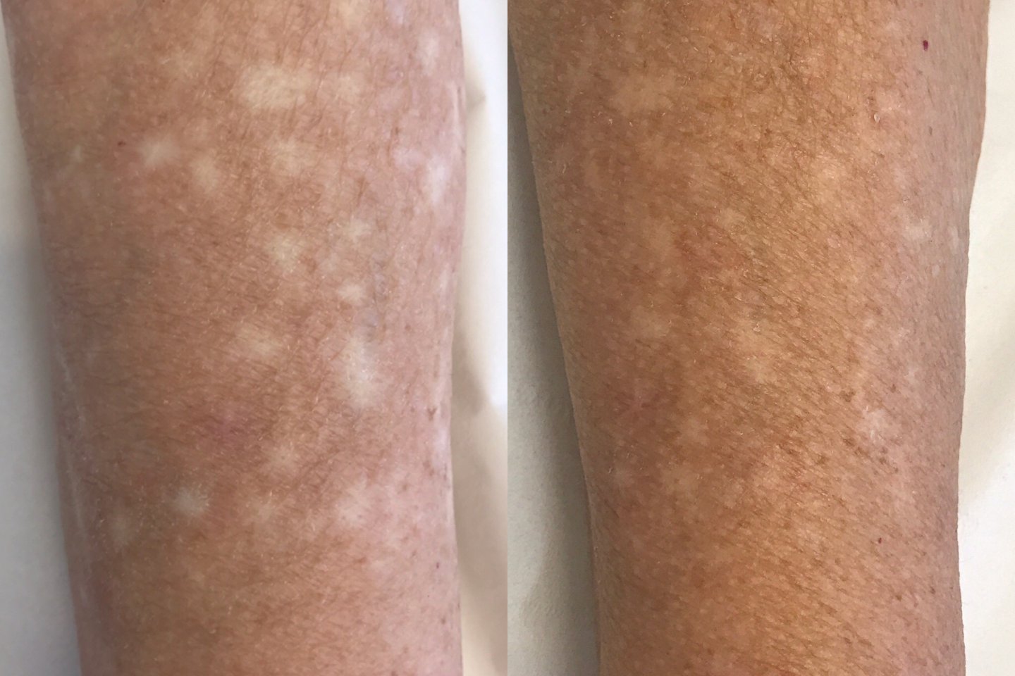 Татуаж на шрамах и рубцах