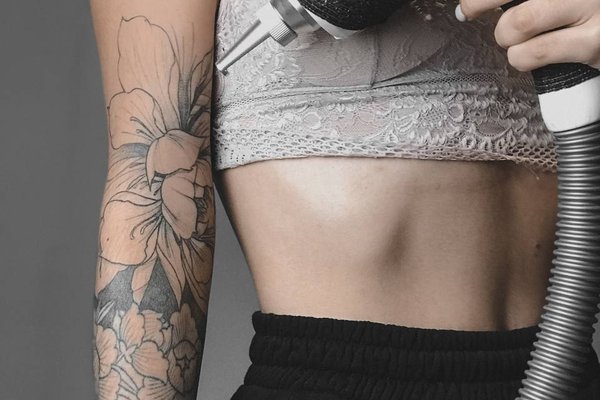 Видалення тату в Запоріжжі