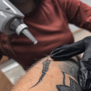 Видалення татуювань у Дніпрі