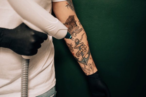 Laser tattoo removal in Dubno