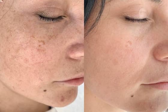 Татуаж кругов под глазами