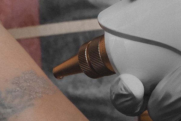 Laser tattoo removal in Dubno