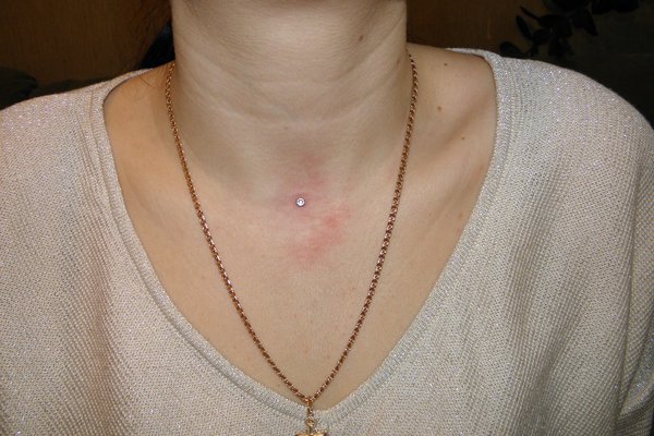 Пірсинг мікродермал