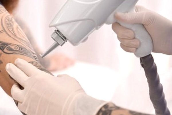 Удаление тату в  Коломые