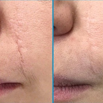 Татуаж на шрамах и рубцах