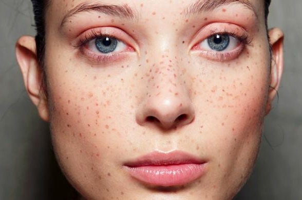 Татуаж веснянок