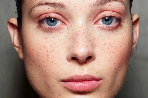 Татуаж веснушек