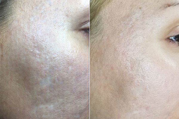 Татуаж на шрамах и рубцах